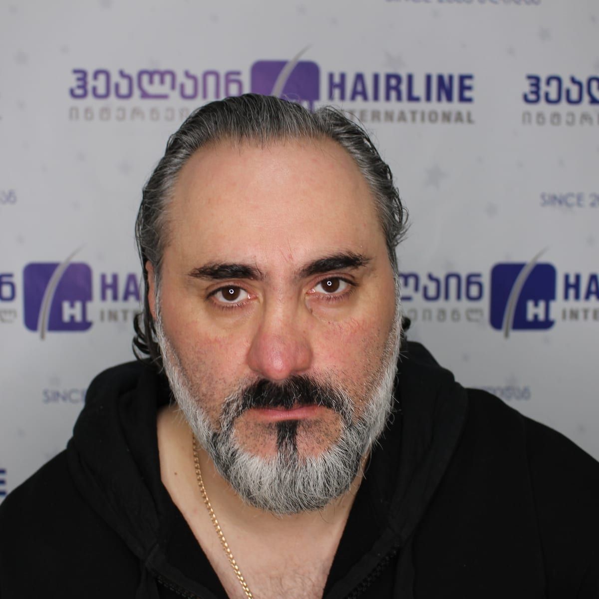 წინიდან – თმის გადანერგვამდე