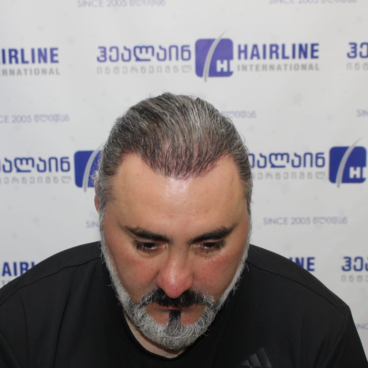 თმის ზრდის ხაზი – თმის გადანერგვიდან 6 თვის შემდეგ