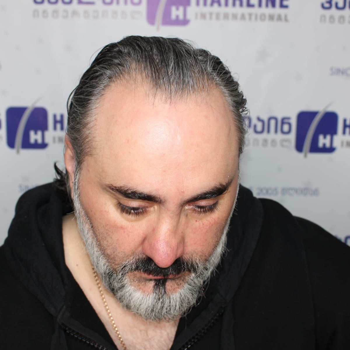 თმის ზრდის ხაზი – თმის გადანერგვამდე