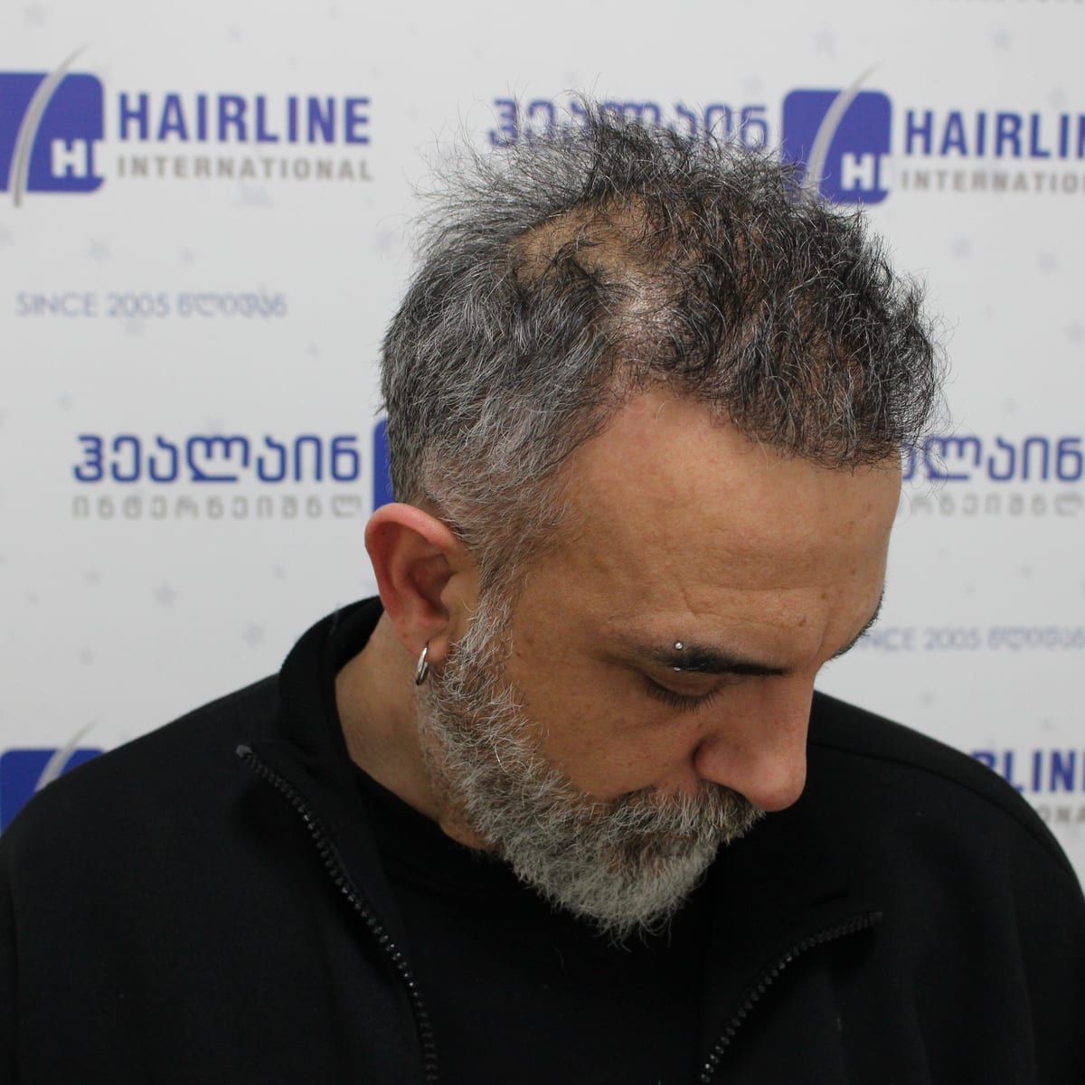 თხემი – თმის გადანერგვიდან 8 თვის შემდეგ