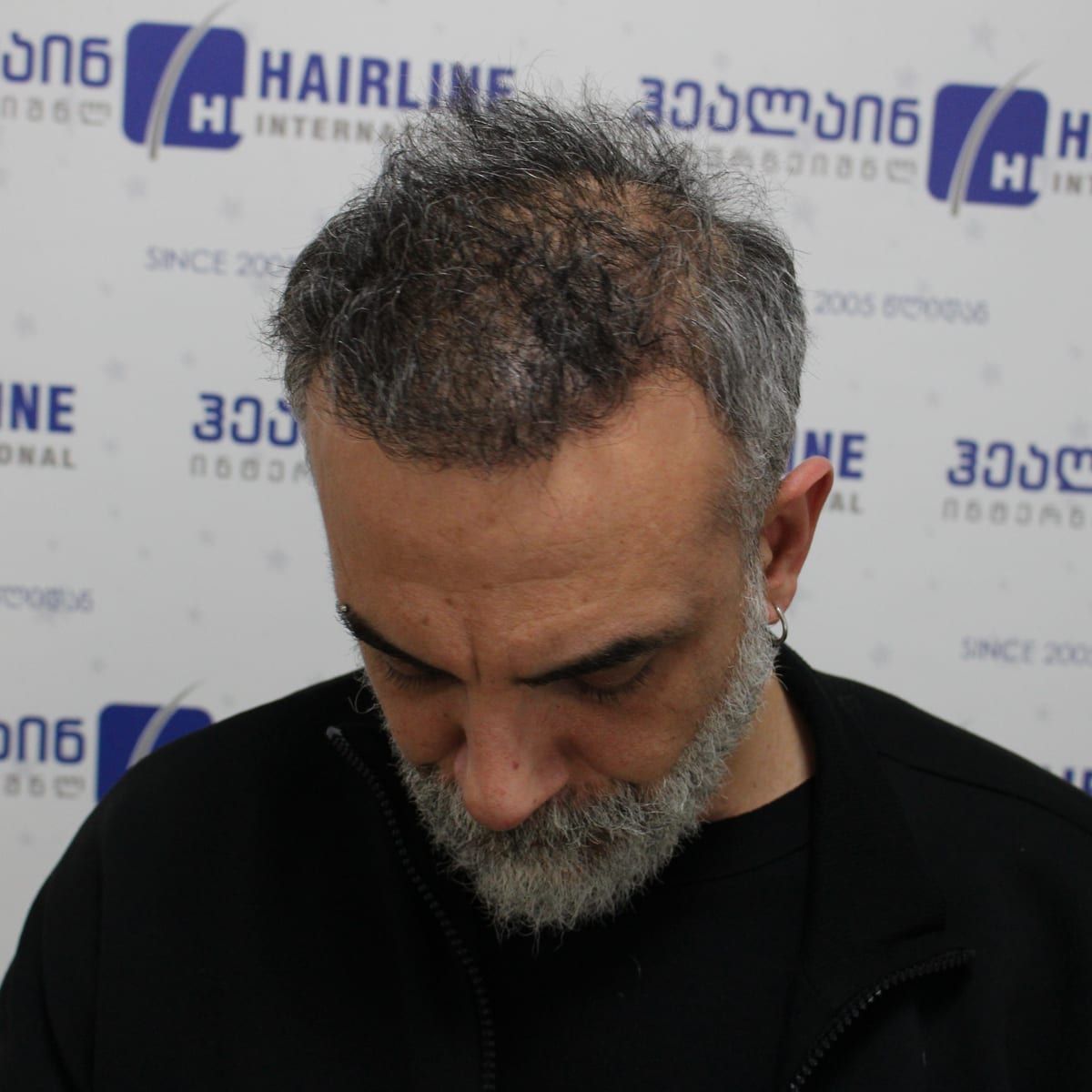 ზემოდან – თმის გადანერგვიდან 8 თვის შემდეგ