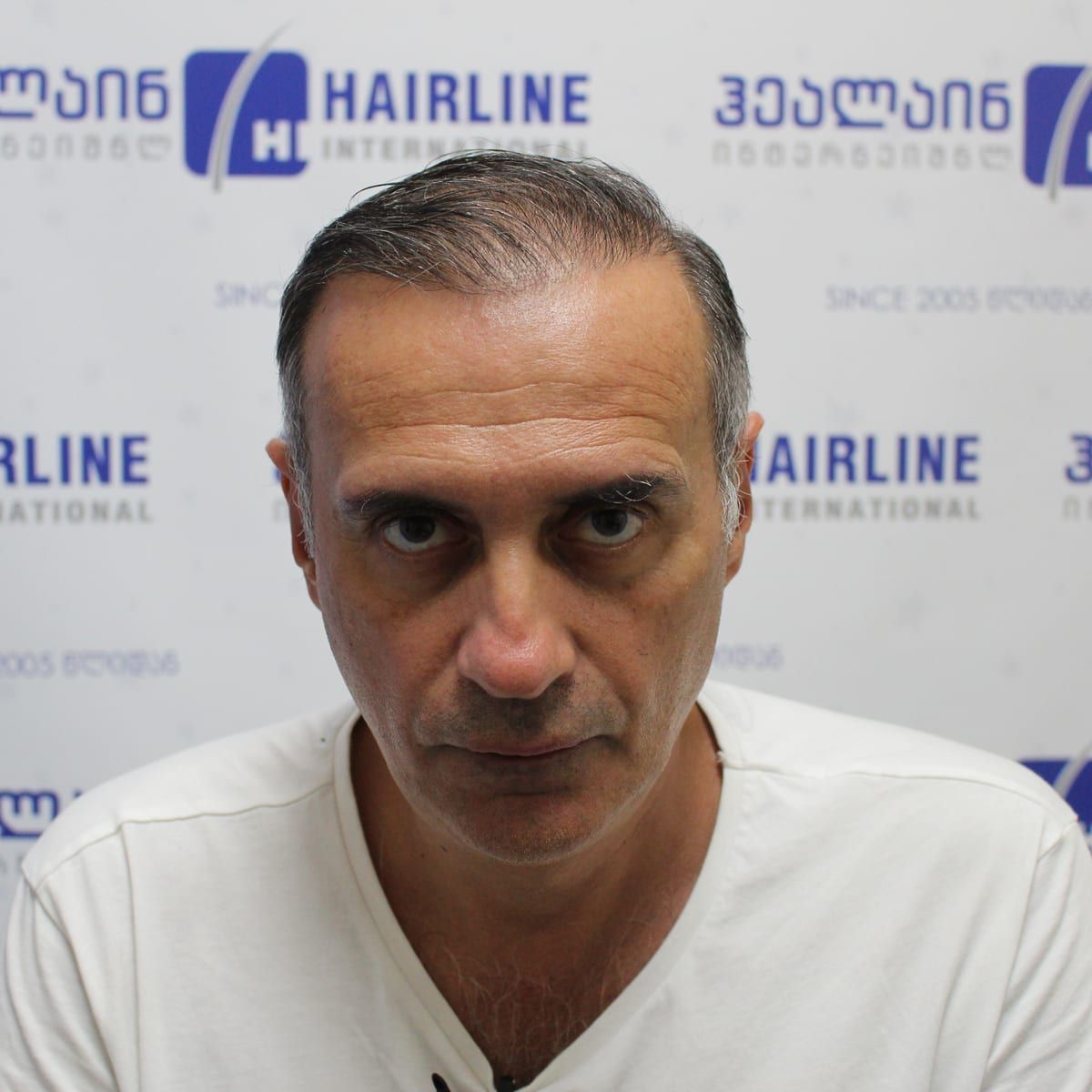 წინიდან – თმის გადანერგვიდან 14 თვის შემდეგ