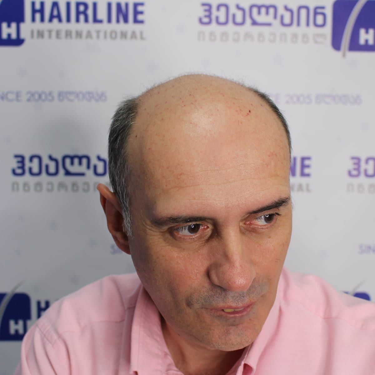 წინიდან – თმის გადანერგვამდე