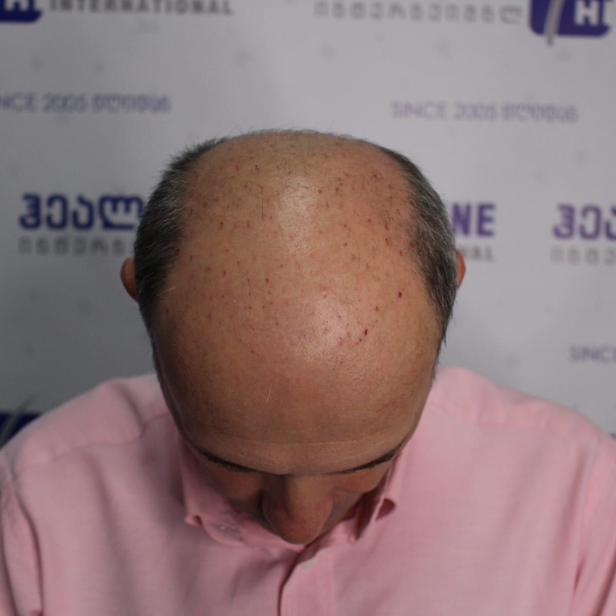 ზემოდან – თმის გადანერგვამდე