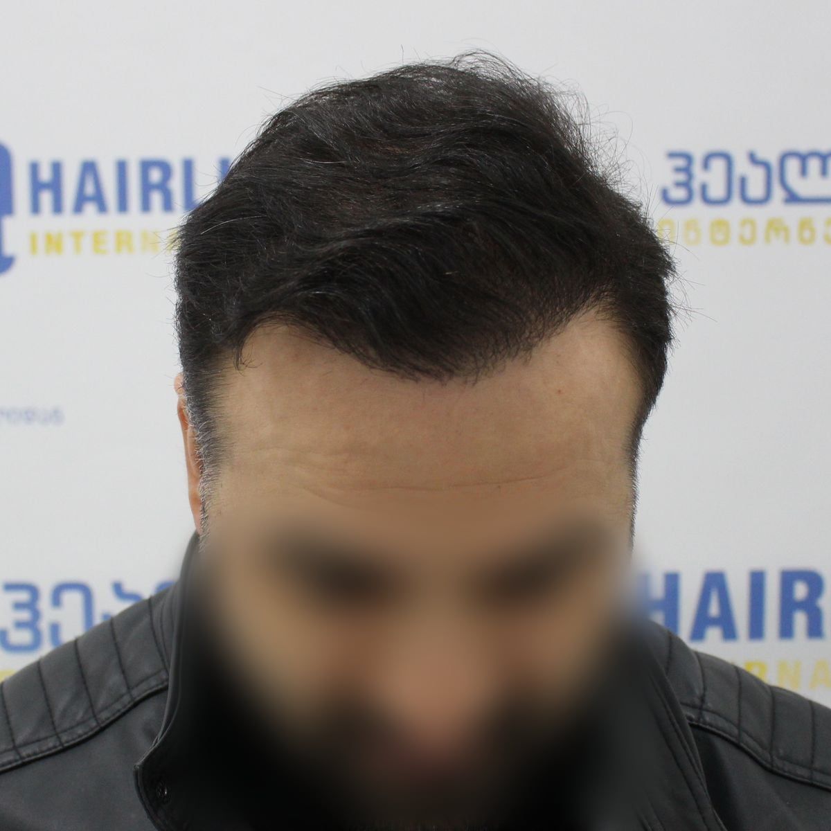 წინიდან – თმის გადანერგვიდან 11 თვის შემდეგ
