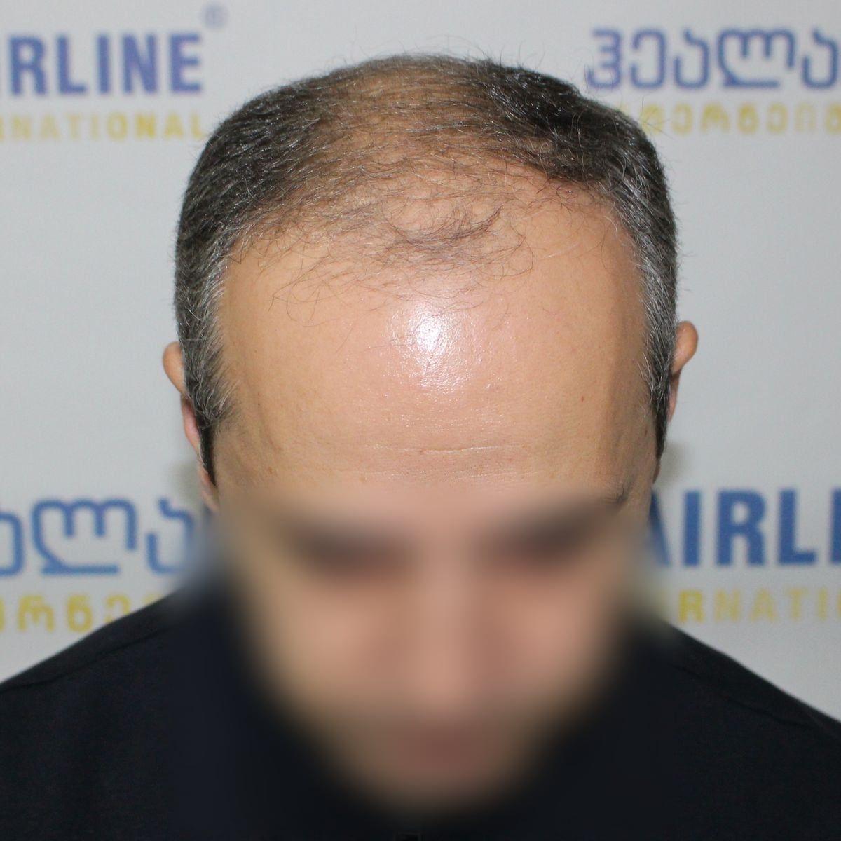 წინიდან – თმის გადანერგვამდე