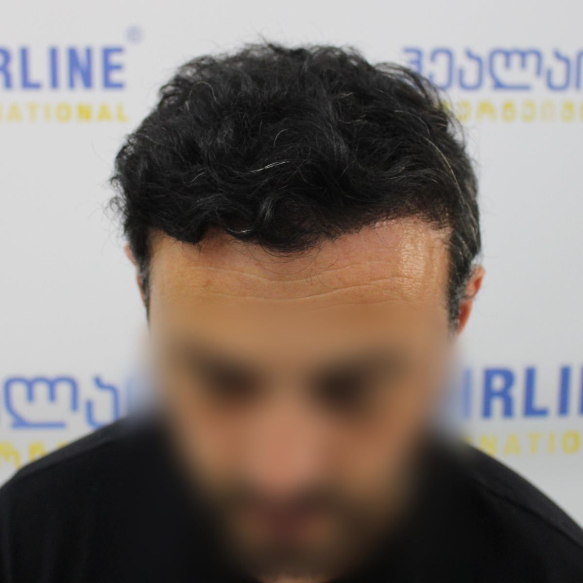 წინიდან – თმის გადანერგვიდან 17 თვის შემდეგ