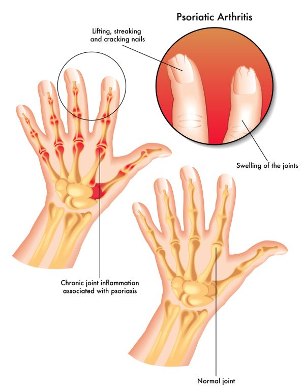 ფსორიაზული ართრიტი Psoriatic Arthritis
