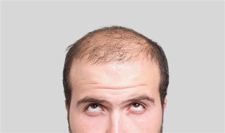 თმის ცვენის ანდროგენული ფორმა, ალოპეცია მამაკაცებში, tmis cvenis androgenuli forma