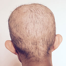 diffusive alopecia