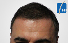 თმის გადანერგვამდე და შემდეგ hair transplant before and after