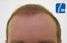 თმის გადანერგვამდე და შემდეგ hair transplant before and after