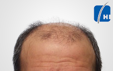 თმის გადანერგვამდე და შემდეგ hair transplant before and after 