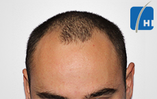 თმის გადანერგვამდე და შემდეგ hair transplant before and after 