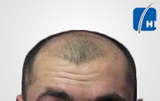 თმის გადანერგვამდე და შემდეგ hair transplant before and after tmis gadanergva
