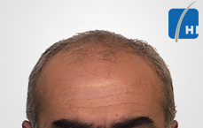 თმის გადანერგვამდე და შემდეგ hair transplant before and after tmis gadanergva