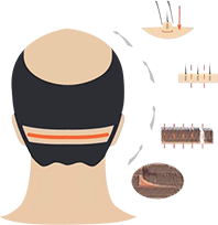 hair transplantation STRIP method